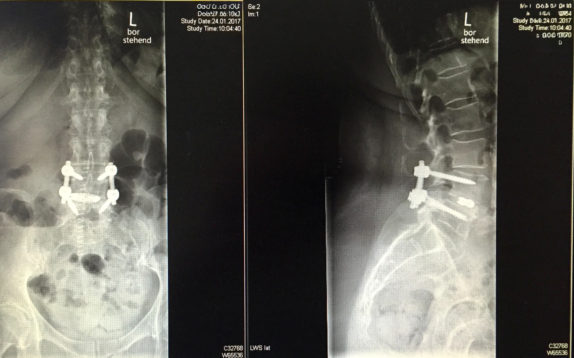 Single-Level Transforaminal Lumbar Interbody Fusion