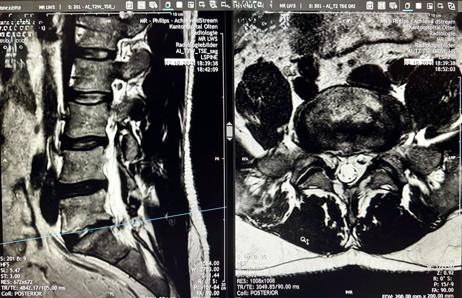 MRI Lumbar Spine