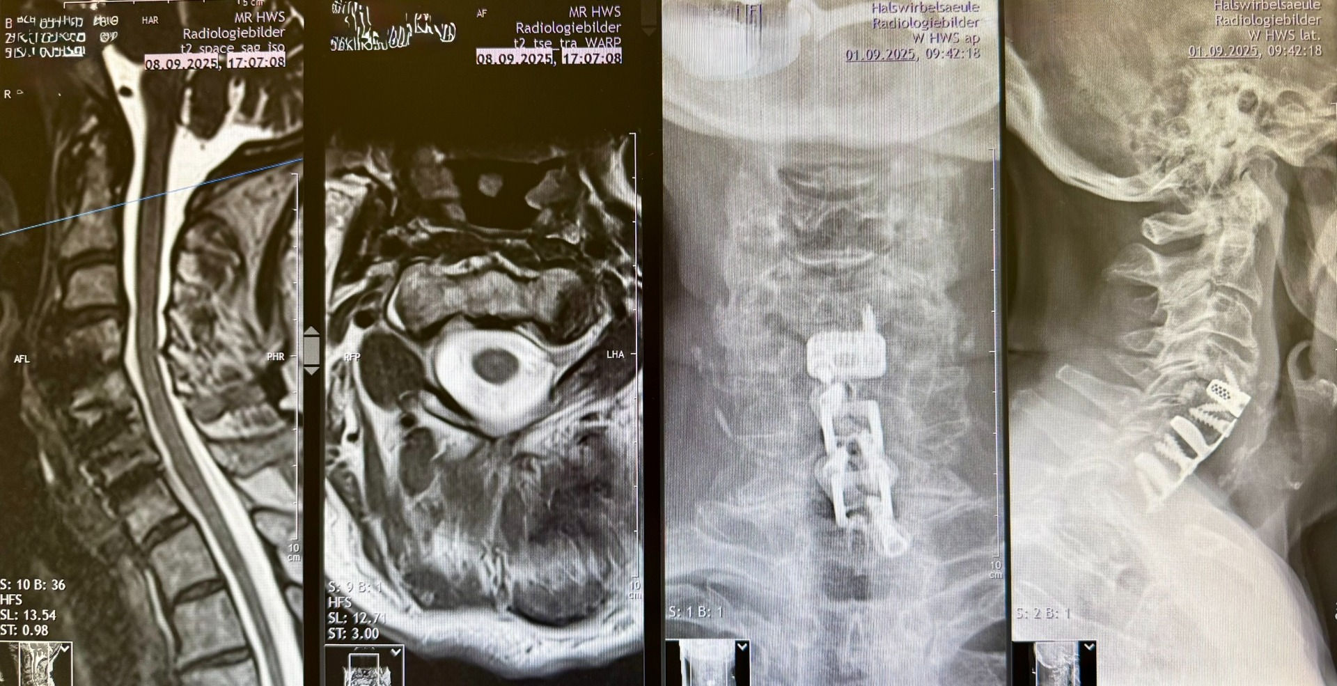 3-Level Anterior Cervical Fusion Decompression
