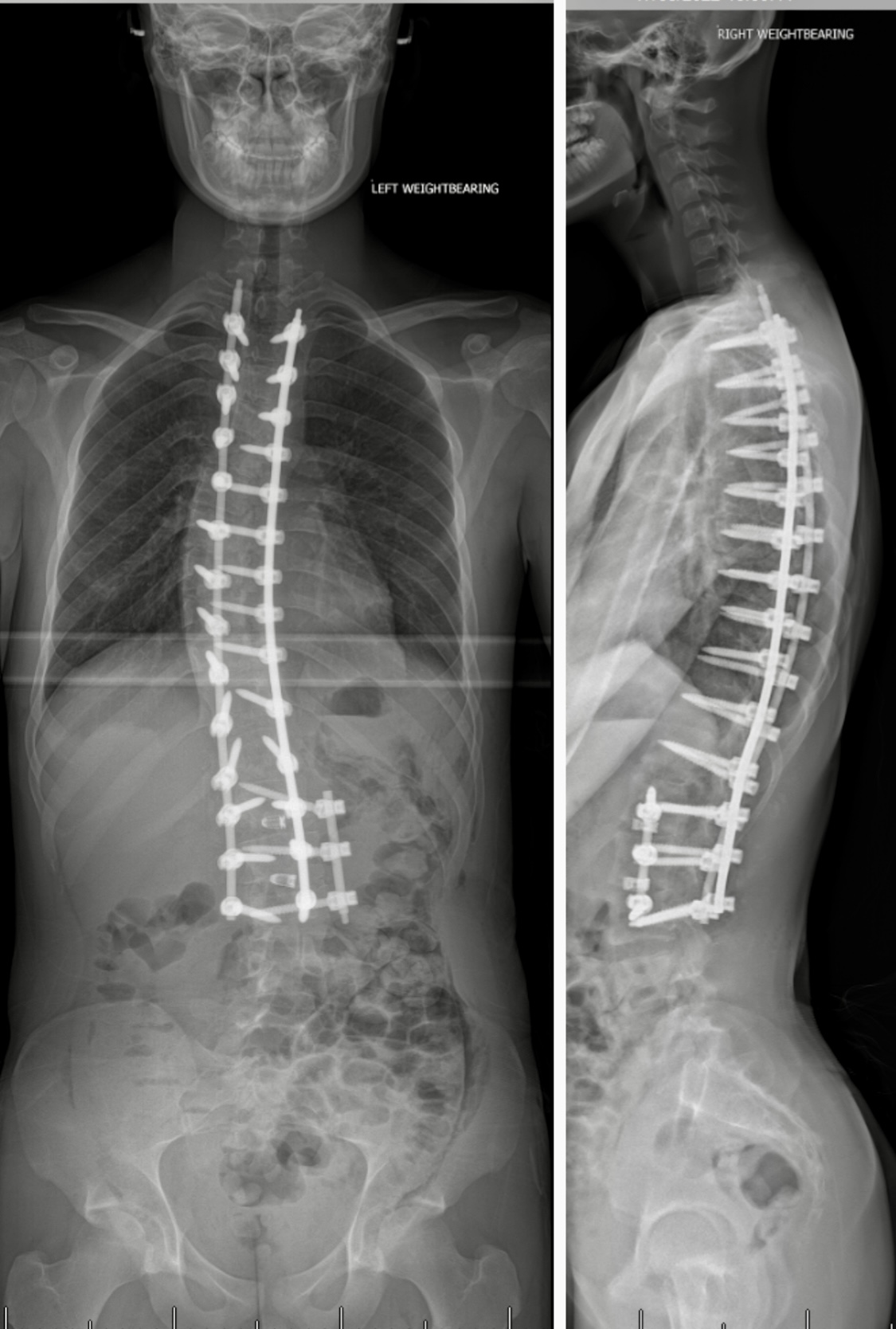 Extended Thoracolumbar Spondylodesis with Idiopathic Scoliosis-Correction