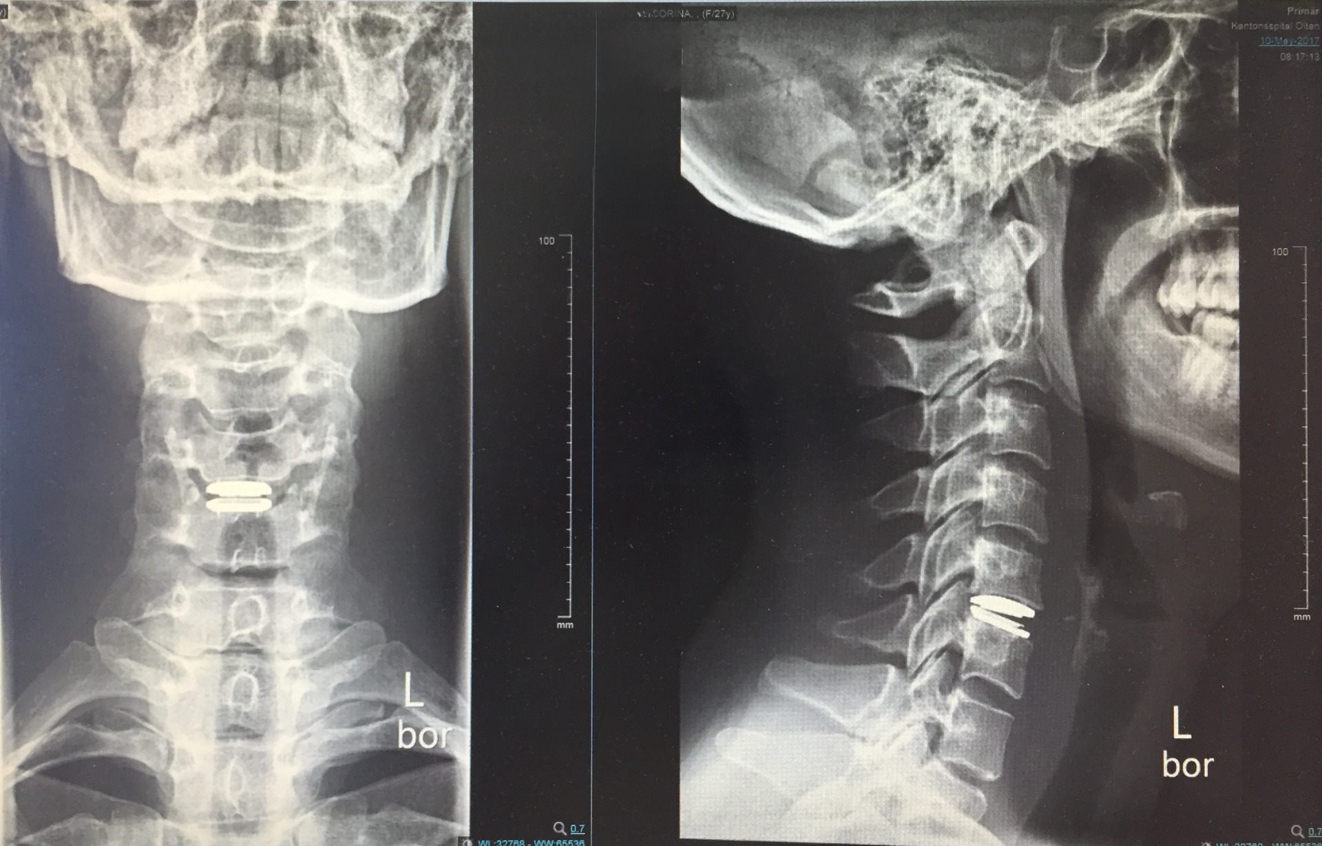Single-Level Anterior Cervical Disc-Prosthesis