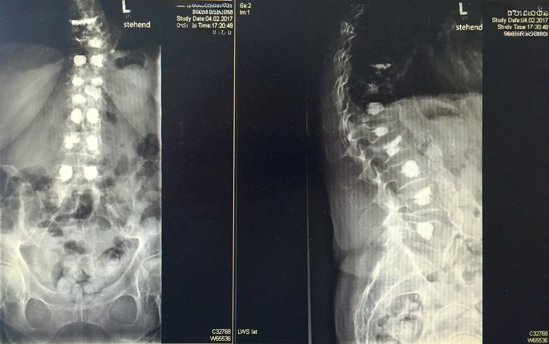 8-Level Transpedicular Bi-& Uni-lateral Vertebroplasty