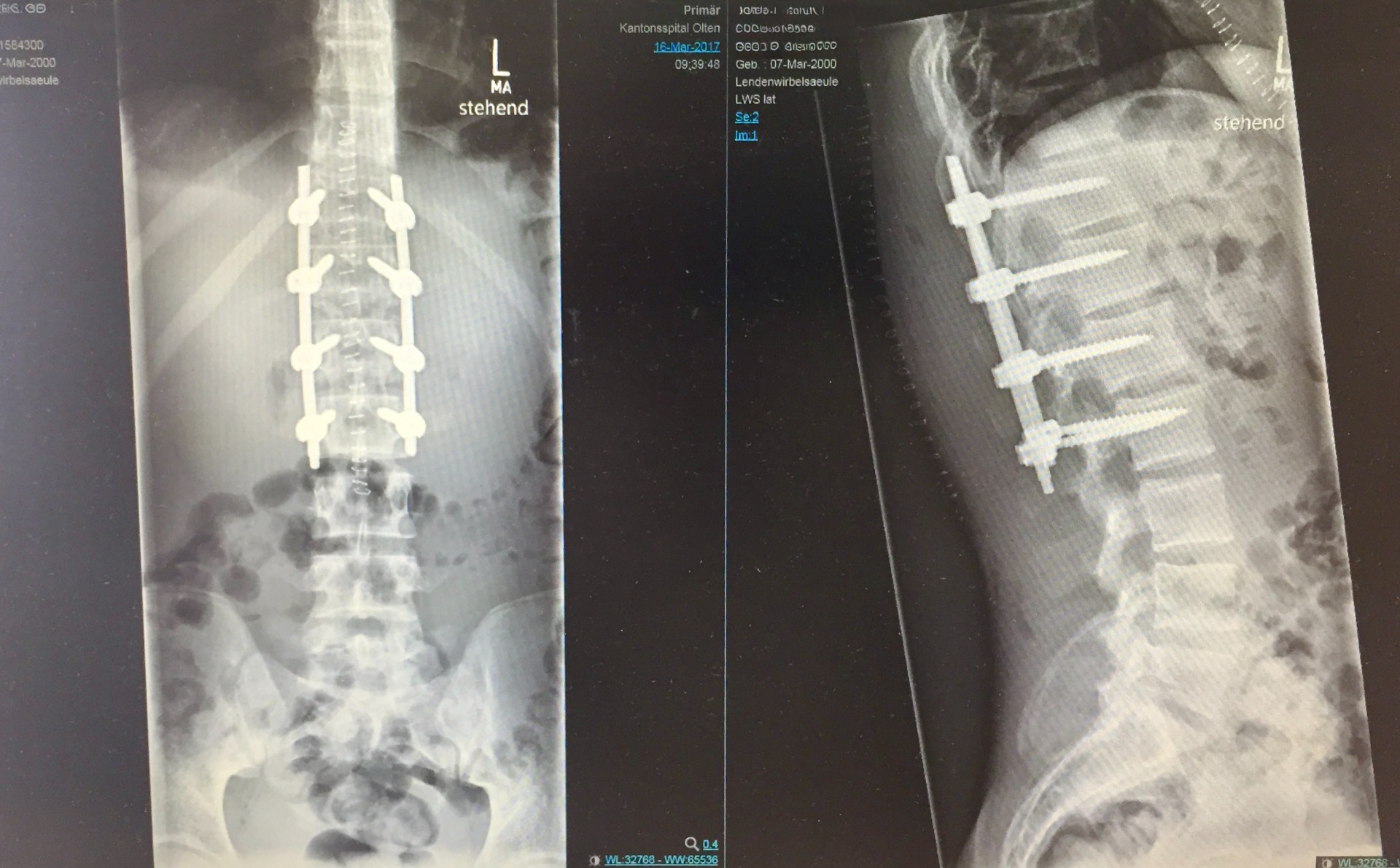 4-Level Minimal Invasive O-Arm-Navigated Dorsal Thoracolumbar Vertebral Body Fracture Fixation