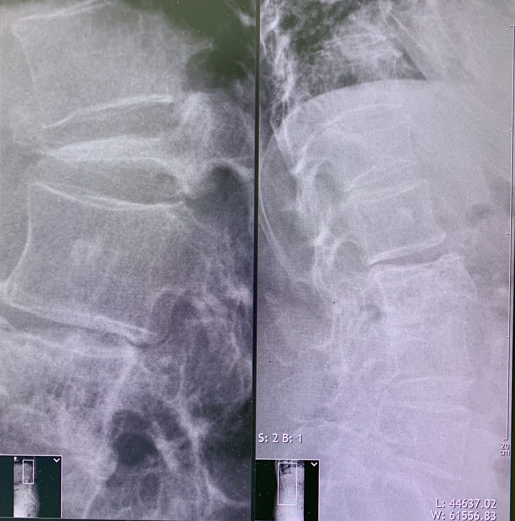 Conservative Treatment of Osteoporotic Wedge-Compression Thoracic Vertebral Body Fracture