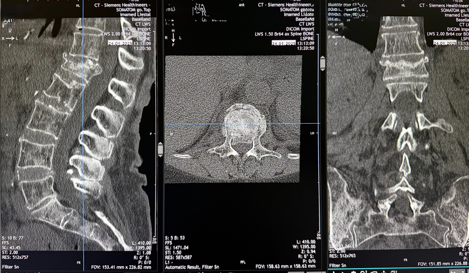 CT-Scan with Lumbar Vertebral Body Fractures