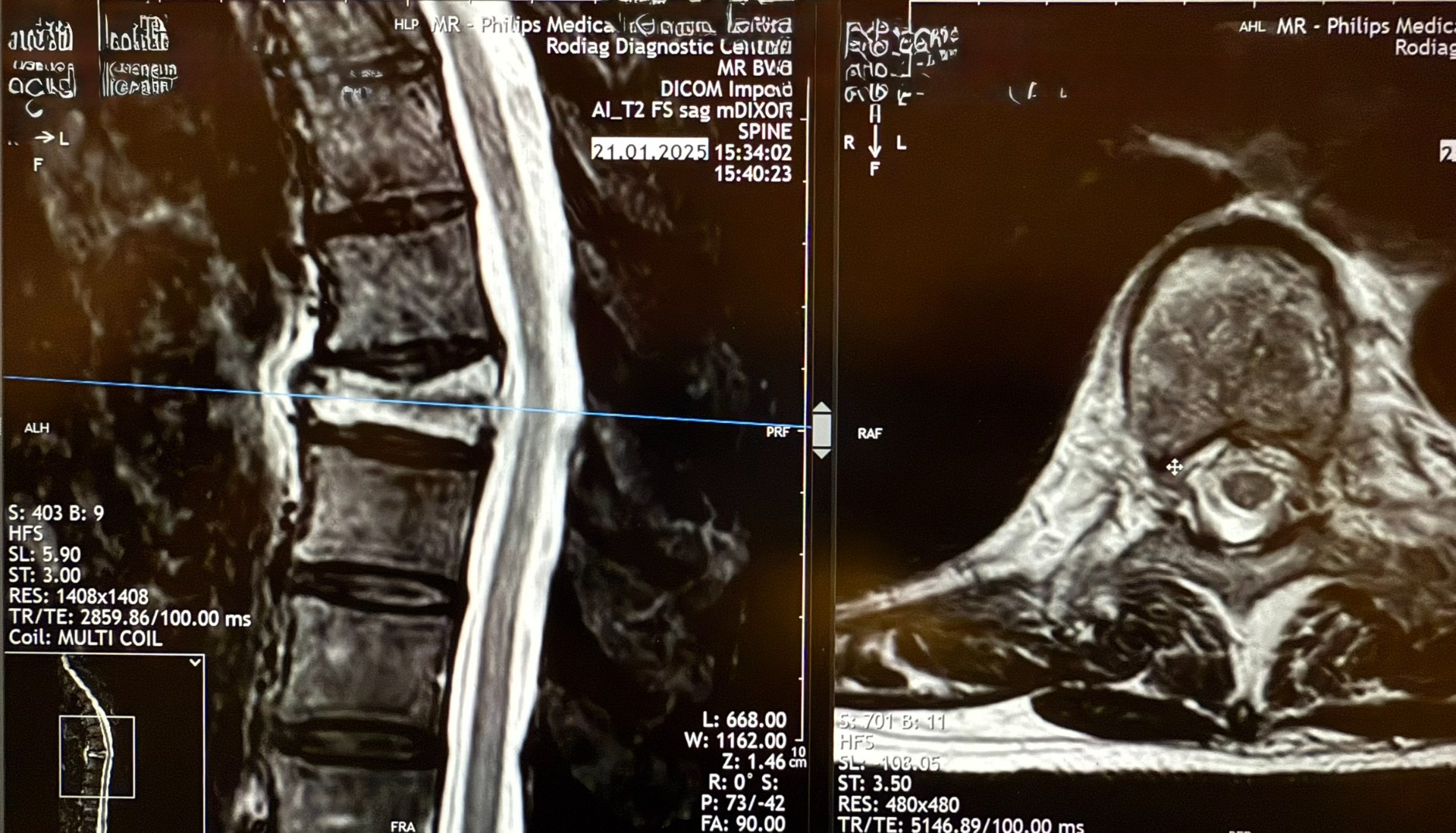 MRI Th-L-Spine with STIR-Sequences showing an acute Thoracic Vertebral Body Fracture