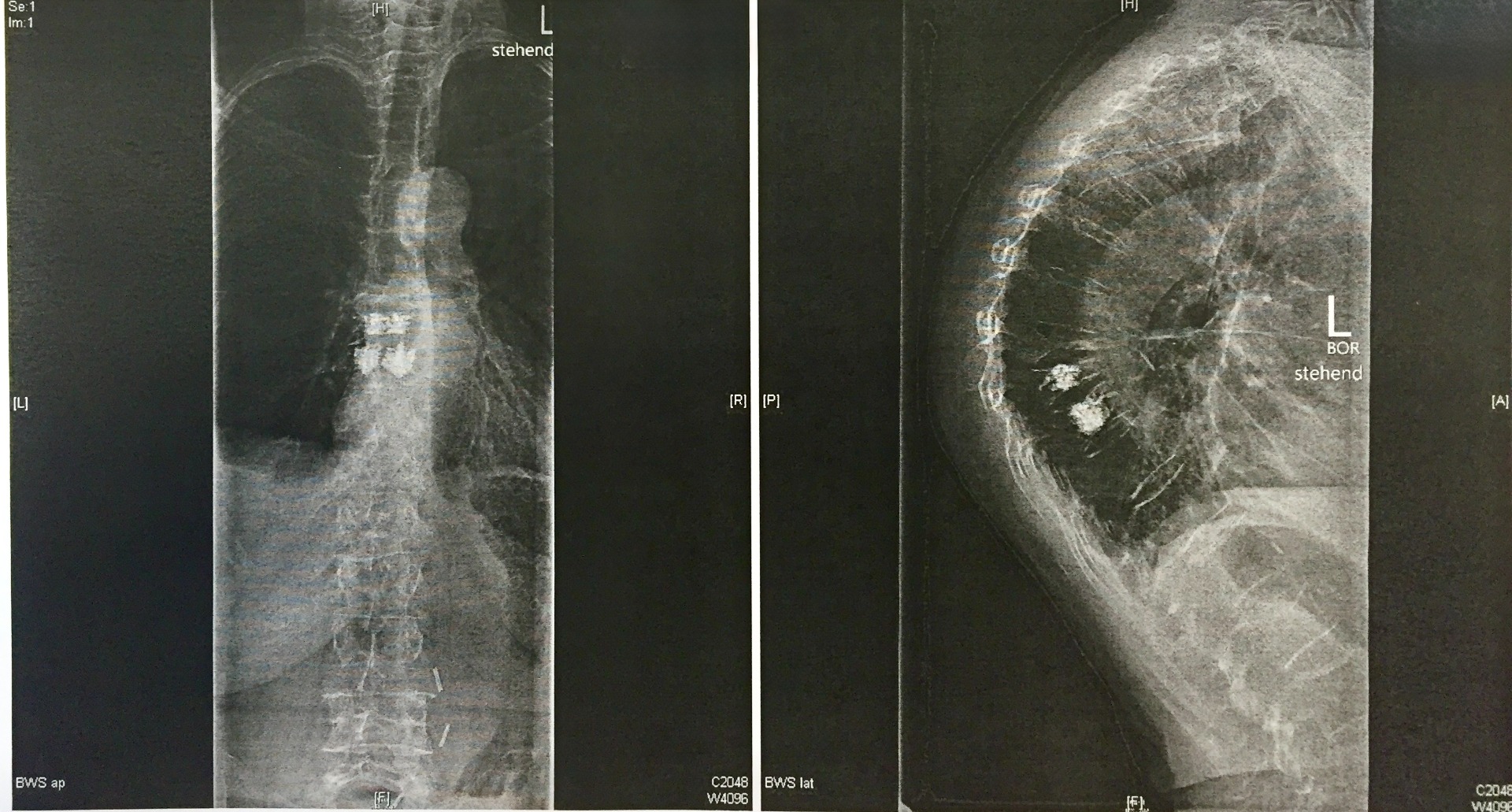 2-Level Transpedicular Vertebroplasty