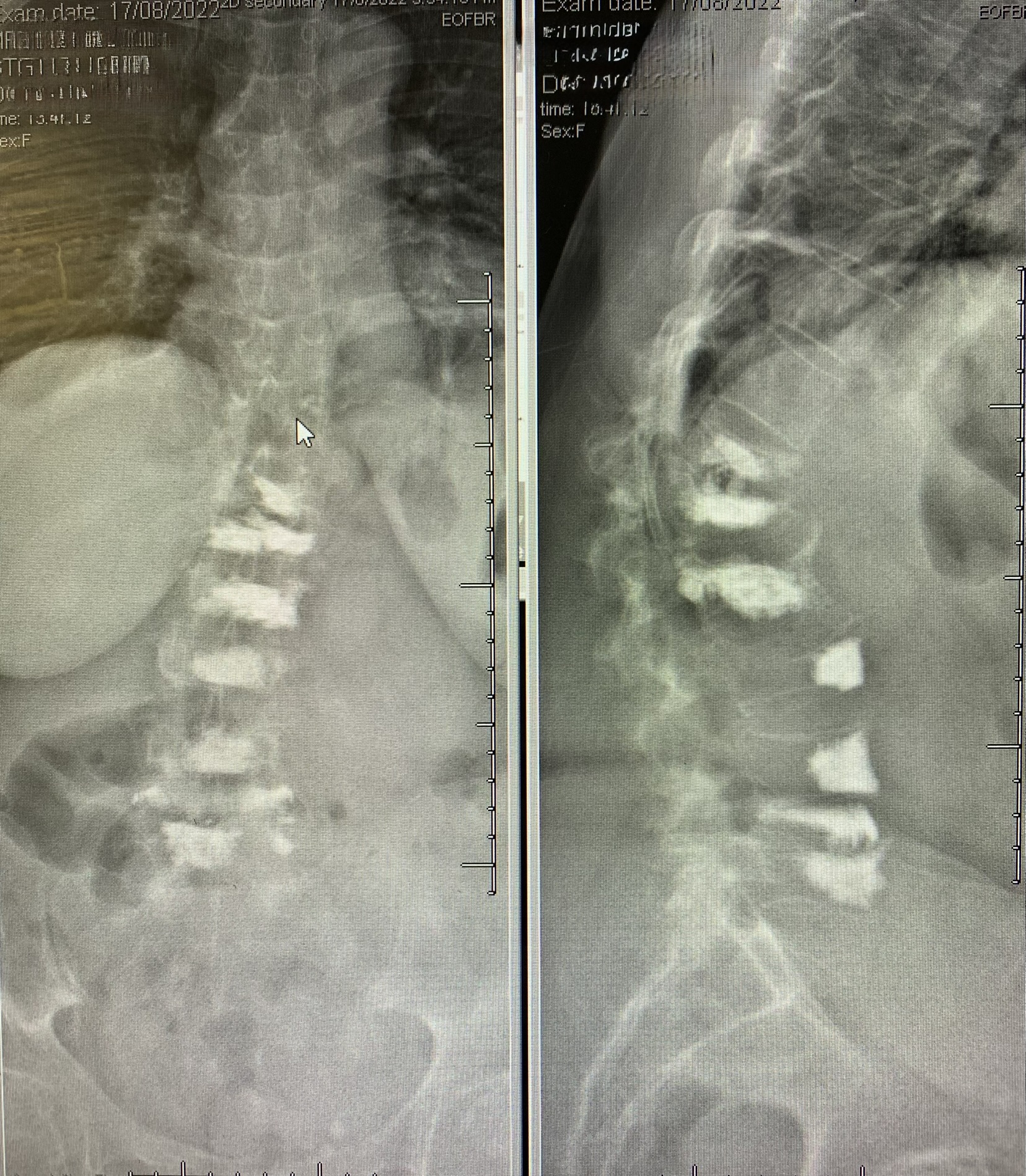 8-Level Transpedicular Vertebroplasty