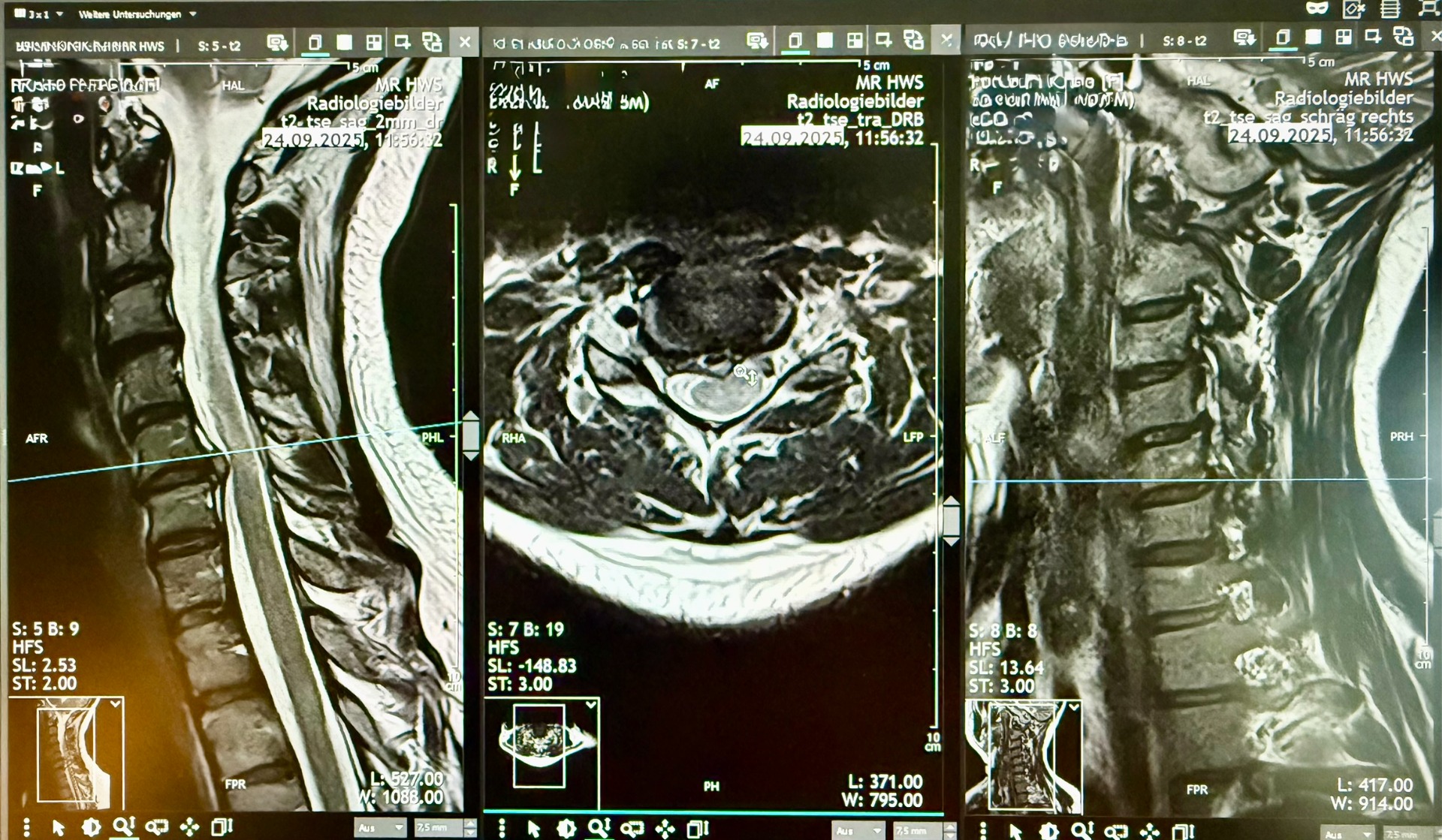 Cervical Stenosis with Myelopathy